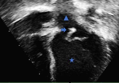 Infective Endocarditis, a Rare Complication of Late Neonatal Group B <mark class="highlighted">Strep</mark> Sepsis